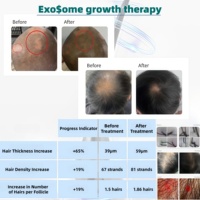 Thérapie de repousse des cheveux anti-chute de cheveux avancée 10 milliards d'exosomes cellules souches EGF Poudre lyophilisée Solution Elixir de croissance des cheveux Accélérateur