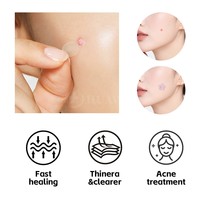 Patchs anti-acné hydrocolloïdes en forme d'étoile pentagonale rose scintillante – Autocollants mignons pour adolescents – Forme/couleur personnalisables