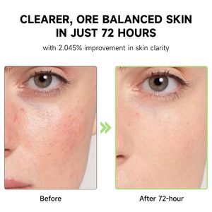 JMFREE Sérum Facial Coreano para el Cuidado de la Piel, 30 ml, Ácido Azelaico 10, Ácido Hialurónico, Calmante, Suavizante de Enrojecimiento, para Piel Sensible - Product Image 4