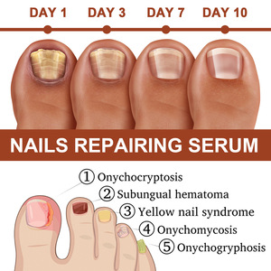 Suero Reparador de Uñas Herbal Efectivo JAYSUING, <span class=keywords><strong>Tratamiento</strong></span> para <span class=keywords><strong>Hongos</strong></span> <span class=keywords><strong>en</strong></span> las Uñas <span class=keywords><strong>en</strong></span> 7 Días - Product Image 6