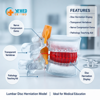 Modelo Anatómico de Columna Vertebral con Hernia Discal Lumbar 1.5X Tamaño Real, Herramienta Médica para Aprendizaje y Enseñanza, CE/ISO