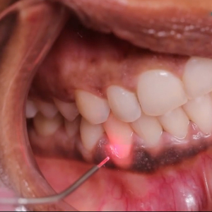 मल्टीफंक्शन डेंटल लेजर थेरेपी 980nm + 1470nm उच्च शक्ति दंत ऊतक लेजर काटने सर्जरी उपकरण - Product Image 6