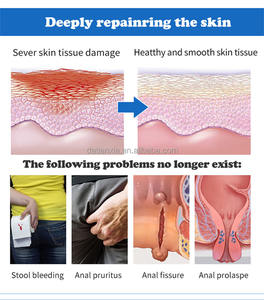 Ungüento de menta para hemorroides, crema para fisura Anal interna y externa, yesos para revivir el dolor, fisura Anal interna y externa - Product Image 6