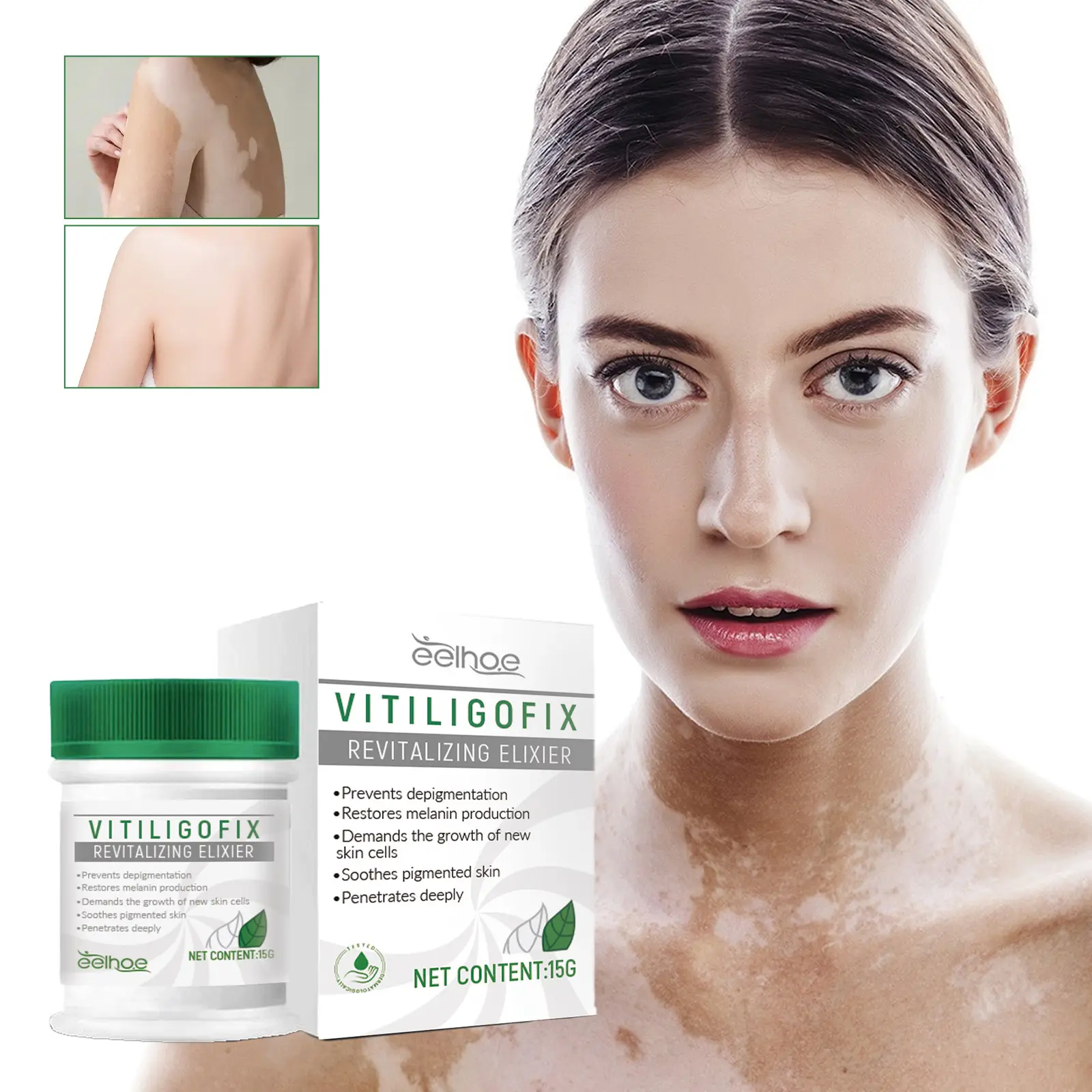 EELHOE Crème pour le Vitiligo Traitement blanchissant pour l'élimination des cicatrices Crème pour la pigmentation du vitiligo