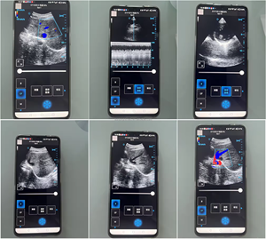 SUN-D7 Peut Utiliser à la Fois le WIFI et le USB Sonde d'Échographie Vétérinaire Sans Fil à Double Tête Mini Machine d'Échographie Sans Fil - Product Image 5