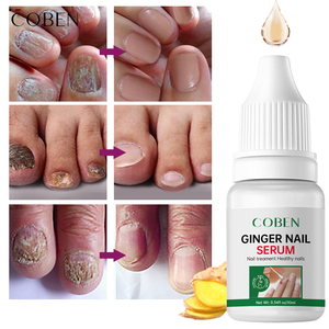 Tratamiento de uñas antiinfección de jengibre <span class=keywords><strong>COBEN</strong></span> para hongos en las uñas de los dedos cuidado de los pies y blanqueamiento brillante Dropshipping - Product Image 5