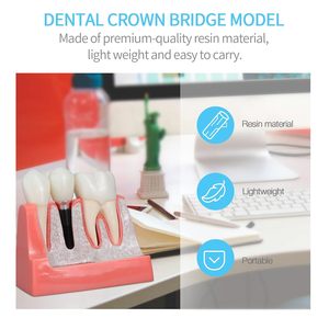 Modèle d'implant dentaire 4 fois plus grand, amovible, pour l'analyse et la démonstration de couronnes et bridges, idéal pour l'enseignement et les études en classe - Product Image 4