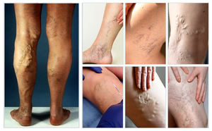 Láser de diodo de longitud de onda dual 980nm + 1470nm Máquina de tratamiento láser endovenoso para ablación de venas varicosas - Product Image 4