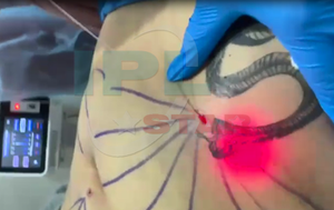 Endolaser Doble mentón debajo de los ojos Comprobar Quemar grasa Apriete la piel Estiramiento facial Máquina de liposucción láser facial 1470nm Láser de diodo - Product Image 6