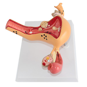 โรงเรียนแพทย์สอนแบบจําลองมนุษย์ของการเปลี่ยนแปลงทางพยาธิวิทยาของมดลูกและรังไข่ในการเจริญพันธุ์ของผู้หญิง - Product Image 4