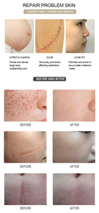 เทคโนโลยีใหม่ เครื่องเลเซอร์ CO2 Fractional 10600nm เครื่องตัดเลเซอร์ CO2 สำหรับการฟื้นฟูผิวหนัง อุปกรณ์ความงาม - Product Image 6