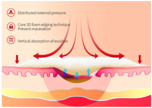 Alexer Pansement en mousse adhésive en silicone avec bordure douce 3 "x 3'' Lot de 5 pour l'ulcère diabétique du pied - Product Image 5
