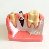 Modèle d'implant dentaire pour la démonstration patiente Modèle de couronne et de pont d'implant dentaire