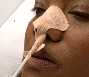 สายสวนยึดในกระเพาะอาหารหลอด NG ยึดจมูกปูนปลาสเตอร์ - Product Image 2