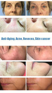 การบำบัดด้วยแสง LED ทางการแพทย์ CE Pdt <span class=keywords><strong>Biolight</strong></span> สีแดง น้ำเงิน เหลือง อินฟราเรด สำหรับรักษาสิวและฟื้นฟูผิว - Product Image 6