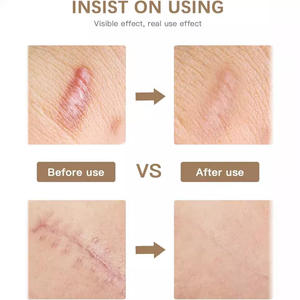 Hoja removedora <span class=keywords><strong>de</strong></span> <span class=keywords><strong>cicatrices</strong></span> <span class=keywords><strong>de</strong></span> silicona impermeable reutilizable <span class=keywords><strong>Tiras</strong></span> <span class=keywords><strong>de</strong></span> cinta <span class=keywords><strong>de</strong></span> cicatriz <span class=keywords><strong>de</strong></span> silicona efectivas - Product Image 4