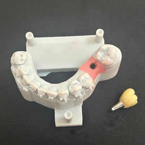 Laboratoire <span class=keywords><strong>dentaire</strong></span> de Chine fraisant tout sur 4 pont de couronne de zircone d'implant avec des piliers en titane - Product Image 4