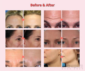 ماكينة التجميل SPA لسطح المكتب 9 في 1 3 ميجاهرتز غسول تقشير رقيق للغاية لإعادة شباب بشرة الوجه وعلاج حب الشباب - Product Image 6