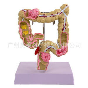 Modelo patológico de intestino grueso, modelo de intestino grueso, modelo gastrointestinal, modelo de enfermedades del colon humano, anatomía de lesiones - Product Image 4