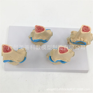 Modelo esquelético patológico de articulación de rodilla en cuatro partes; modelo de articulación de rodilla patológica/con lesiones; articulación degenerativa. - Product Image 5