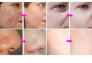 Oxygen Jet Clean Dermabrasion Rejuvenation Water Microdermabrasion Spa Treatment Systems Beauty Facial Machine - Product Image 5