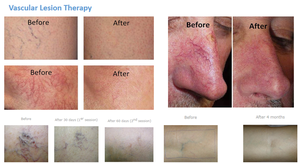 30W EVLT EVLA 980nm 1470nm Terapia de <span class=keywords><strong>luz</strong></span> roja Vaso sanguíneo Eliminación de venas varicosas Máquina quirúrgica láser endovenosa - Product Image 5