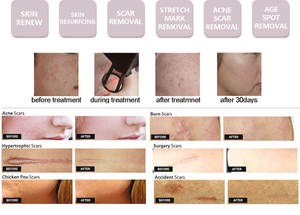 Cilt sıkılaştırma kesme Nevus kaldırma CO2 lazer vajinal gençleştirme el aleti için profesyonel Co2 fraksiyonel lazer - Product Image 3