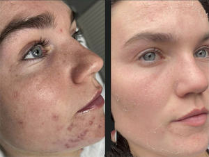 OEM/ODM Biomicroneedling Thérapie Spongilla Spicules Bio Microneedling Thérapie Élimination de l'acné Naturel Sans médical Sans acide - Product Image 2