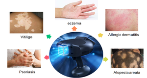 Penganalisis kulit Laser Excimer 308nm, alat perawatan penyembuhan Vitiligo Mini 308nm untuk Vitiligo - Product Image 6