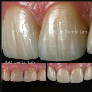 Buen <span class=keywords><strong>Precio</strong></span> Chapa Dientes Restauración <span class=keywords><strong>de</strong></span> porcelana Blanqueamiento dental Preparación mínima Carillas <span class=keywords><strong>dentales</strong></span> - Product Image 6