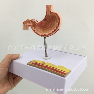 Modelo gástrico patológico en miniatura; modelo gástrico patológico perforado del estómago humano; gastroenterología; coronal - Product Image 4