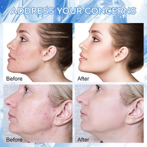 Suero de Ácido Hialurónico OEM para Blanquear la Piel, Microagujas, Suero de ADN de Salmón PDRN - Product Image 6