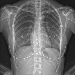 Sistema di Radiografia Digitale ad Alta Risoluzione IRay, Macchina a Raggi X con Rilevatore a Pannello Piatto 17*17 Cablato/Wireless - Product Image 6