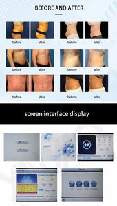 เครื่องแช่แข็งไขมันด้วยความเย็นแบบใหม่ พร้อมหัวจับ 5 หัว สำหรับการสลายไขมันและกระชับสัดส่วนด้วยความเย็น - Product Image 5