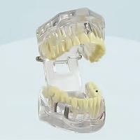 Modèle anatomique dentaire standard de pont amovible pour la restauration des dents, Typodont, Modèle de maladie implantaire, Matériau PVC, Vert, Science Médicale