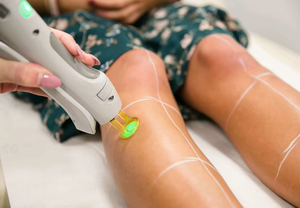 Appareil professionnel d'épilation permanente à double longueur d'onde (1064 nm et 755 nm) à impulsions longues pour le corps et le visage, adapté à tous les types de peau - Product Image 5