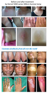 Système Excimer 308 nm : Appareil de Traitement du Vitiligo à Lumière Excimer Monomode 308 nm pour <span class=keywords><strong>Taches</strong></span> <span class=keywords><strong>Blanches</strong></span> et Mélanine Cutanée - Product Image 6
