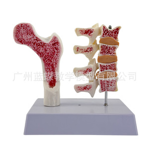 Modèle anatomique d'ostéoporose fémorale humaine, surface anatomique de l'os de la jambe, spécimen de section vertébrale, vertèbre lombaire malade - Product Image 3