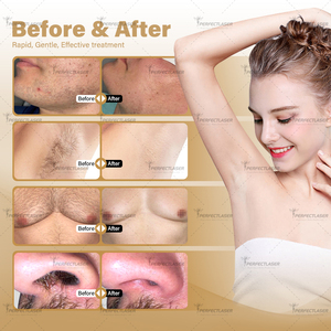 Perfectlaser - Poignée magnétique - Diode laser pour l'épilation - Tête de traitement légère - Fonctionnement facile - Appareil de beauté professionnel - Product Image 6