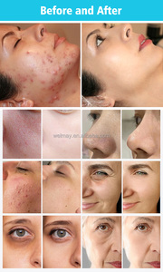 New mụn đầu đen Remover Vacuum mặt hydradermabrasion Microdermabrasion vẻ đẹp thiết bị dermabrasion mụn đầu đen loại bỏ thiết bị - Product Image 6