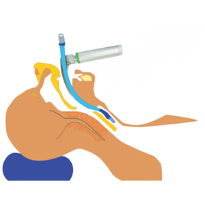 Ensemble de laryngoscope direct macintosh mccoy laryngoscope fibroscope dispositif d'intubation ent laryngoscope à fibre optique portable - Product Image 2