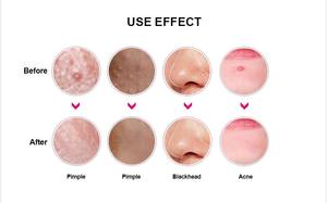 เครื่องกำจัดสิวหัวดำหัวขาวหัวขาวแบบเดี่ยวทำจากสเตนเลสดูแลผิวหน้า - Product Image 6