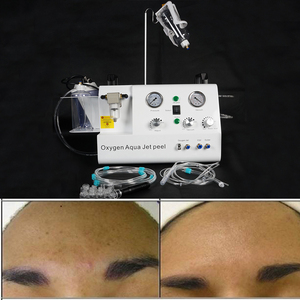 Máquina de Cuidado Facial 5 en 1, Aqua Peel, Portátil, con Oxígeno, Hidrodermoabrasión, Exfoliante Facial, Microdermoabrasión con Punta de Diamante - Product Image 4