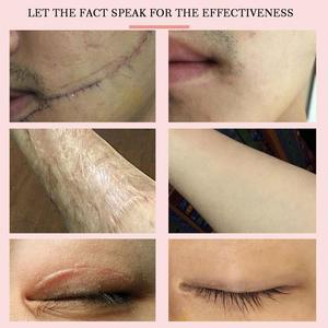 Kem trị sẹo Yoxier Lavender, 20g - Loại bỏ sẹo & vết thâm mụn, chống viêm & phục hồi da - Product Image 4