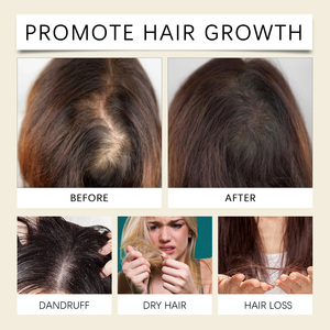 Aceite para el Crecimiento del Cabello <span class=keywords><strong>de</strong></span> Romero y Ricino 100% Natural <span class=keywords><strong>de</strong></span> Marca Privada al por Mayor, Suero Anticaída y Fortalecedor para el Cuidado del Cuero Cabelludo - Product Image 6