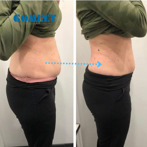 Máquina de Adelgazamiento Láser Lipo de 980nm 1470nm de Nuevo Diseño, Endoláser Mínimamente Invasivo para Lifting Facial, Pérdida de Grasa y Eliminación de Grasa Rebelde - Product Image 6