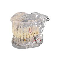 Modèle dentaire amovible de pont de restauration de dents modèle de maladie de dent d'implant