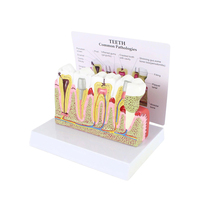 Modèle de pathologie dentaire Modèles de dents dentaires Modèle d'anatomie de la carie en plastique Équipement éducatif détachable médical Formation des dents