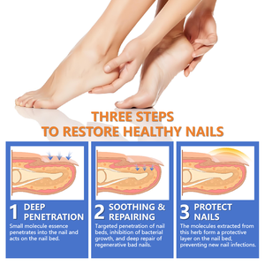 Soins des pieds, herbes naturelles chinoises, 30 ml, meilleur traitement pour les infections fongiques des ongles des pieds et réparation des ongles fongiques - Product Image 6