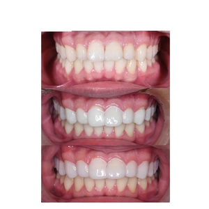 Feuilles de thermoformage sous vide pour la couleur des dents, feuilles de thermoformage dentaire A1 OM1 pour cosmétiques - Product Image 3